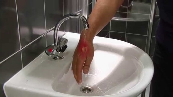 Eerste hulp bij brandwonden | Wat te doen bij een brandwond - 101BHV.nl